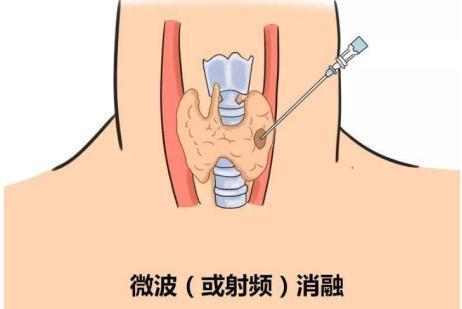 名医专访 | 山东省耳鼻喉医院邹纪东：甲状腺疾病的诊断和治疗