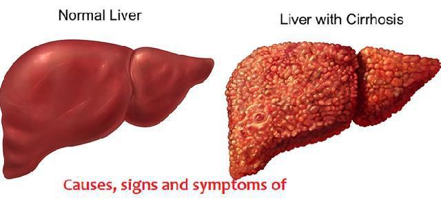 乙肝携带大半生，到老年肝炎发作：9个关键词带你了解老年性乙肝