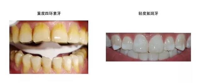 唇红齿“黄”？好牙变黄的原因是什么？
