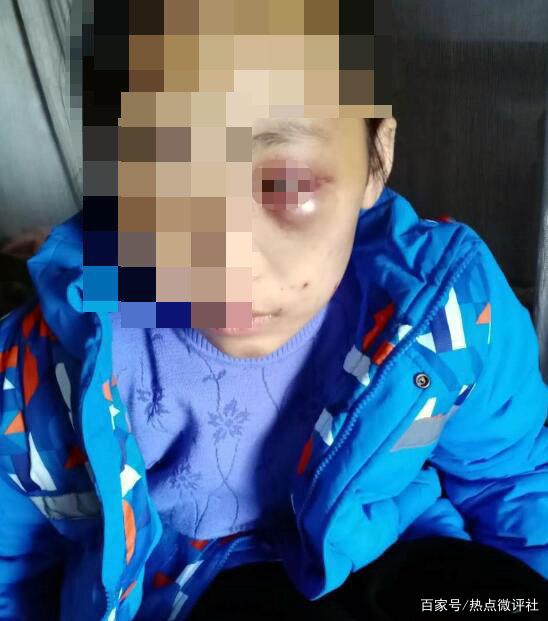 恶毒！12岁女孩“眼睛”被打肿，养母：教育不当，下手重了点！