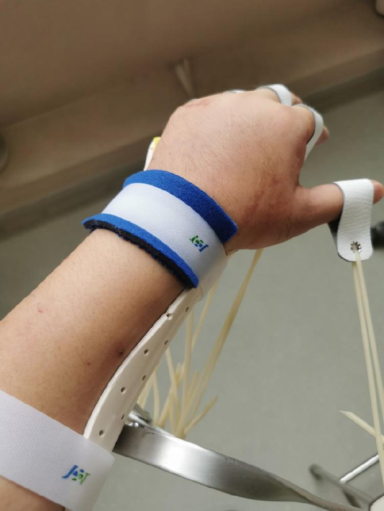 被砍伤84天后陶勇医生出院:虽已适应,但很难恢复