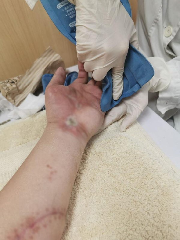 被砍伤84天后陶勇医生出院:虽已适应,但很难恢复