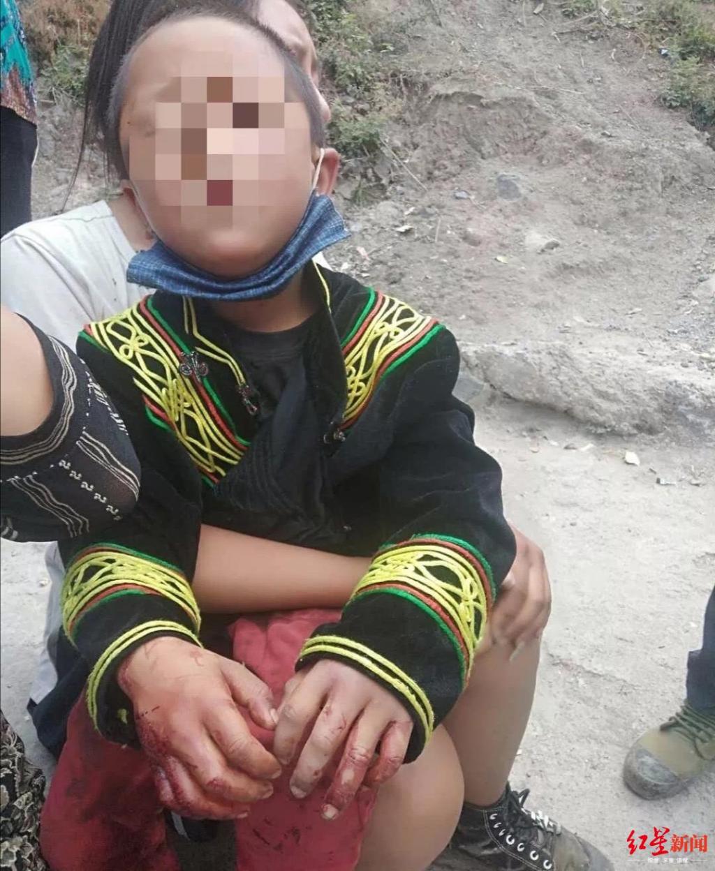 凉山一村庄野猴出没,两小孩被咬伤住院,其中3岁娃受伤较重