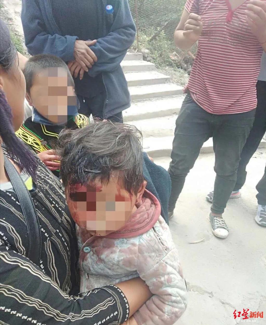 凉山一村庄野猴出没,两小孩被咬伤住院,其中3岁娃受伤较重