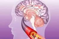 脑血栓发生前，身体会出现哪些信号？