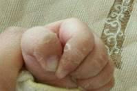 宝宝手部脱皮是缺维生素吗？