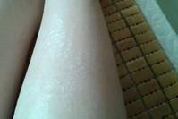 脱秋裤后，腿上总有很多“皮屑”，到底是皮肤病还是皮肤过于干燥