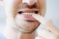 90后掉牙的元凶——牙周炎，预防才是硬道理