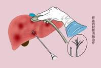 警惕肝癌早期症状 别被“蒙在鼓里”，春季养肝要打通这“二脉”