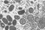 美国猴痘确诊病例近1500例，专家批政府应对不力